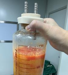 鄢陵水动力吸脂手术要做多久？